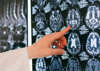 머리 큰 사람들 의문의 1승?…"머리 작고 교육 수준 낮으면 치매위험 쑥"