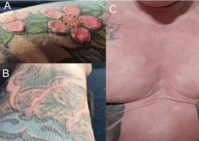 "문신 하나 했을 뿐인데"…전신 탈모에 땀샘 파괴된 30대 남성, 학술지에도 보고