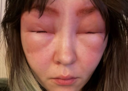 "13일간 집 밖 못 나가"…미용실이라 방심했다가 '염모제 알레르기' 피해 