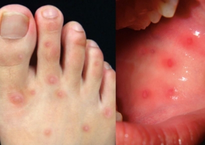 확진 숨기고 학교갔다가 집단감염…"심하면 사망한다" 대만 발칵