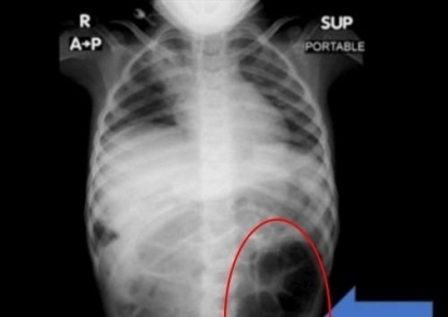 복통 호소하던 여아…위장 속에 '이것' 뭉쳐 있었다