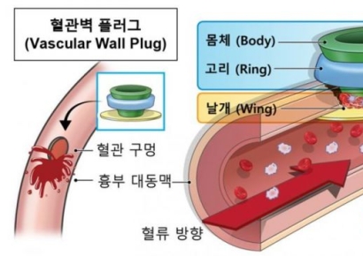 혈류 조절해 스스로 혈관 봉합하는 폐쇄장치 개발
