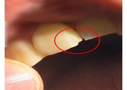 "햄버거에서 '금속 볼트' 나왔다"…치아 부서졌는데 본사는 "원인불명"