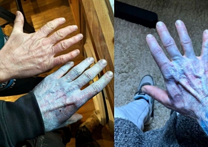 "자고 일어나니 온몸이 '아바타'처럼 변했다"…파랗게 변한 피부에 응급실까지, 무슨 일