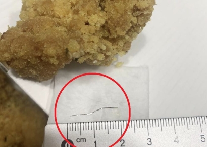 치킨 먹다 구토, 목에 2㎝ 철사 박혔는데…치킨회사 책임 없다고?[최석진의 로앤비즈]