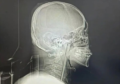 "이게 8년 됐다고요?" 충격받은 의사…12㎝ 젓가락 삼키고 버틴 남성