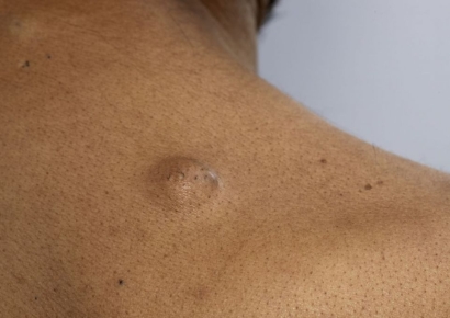 “갑자기 솟아오른 혹”… 암의 신호일까? 흔한 지방종일까?