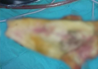 수술 뒤 복통 때문에 찾은 병원서 발견된 '이것'…결국 장 일부 도려냈다